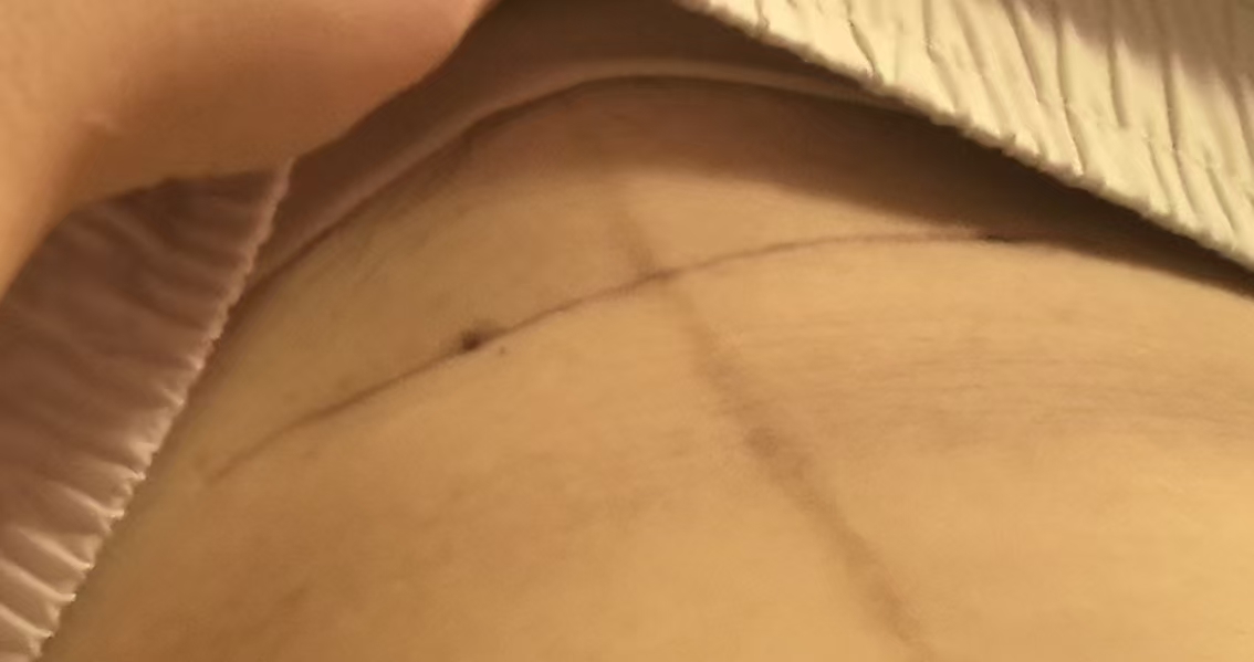 孕晚期剖腹产前的纠结与经验分享