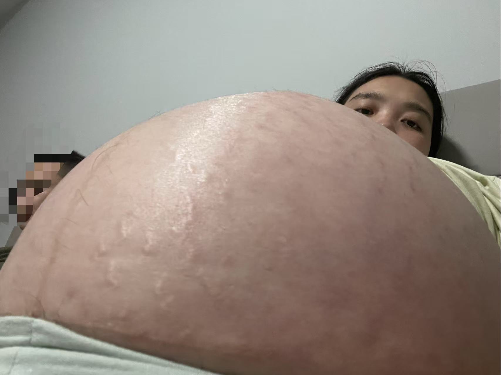 孕晚期肚子痛需要提前剖腹产吗？