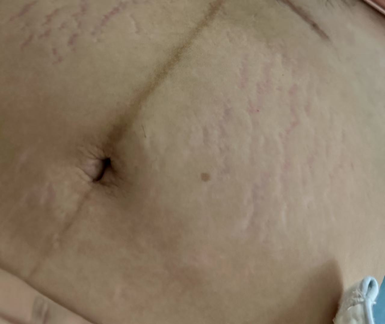 孕晚期肚子痒得睡不着，妊娠纹爆发怎么办？