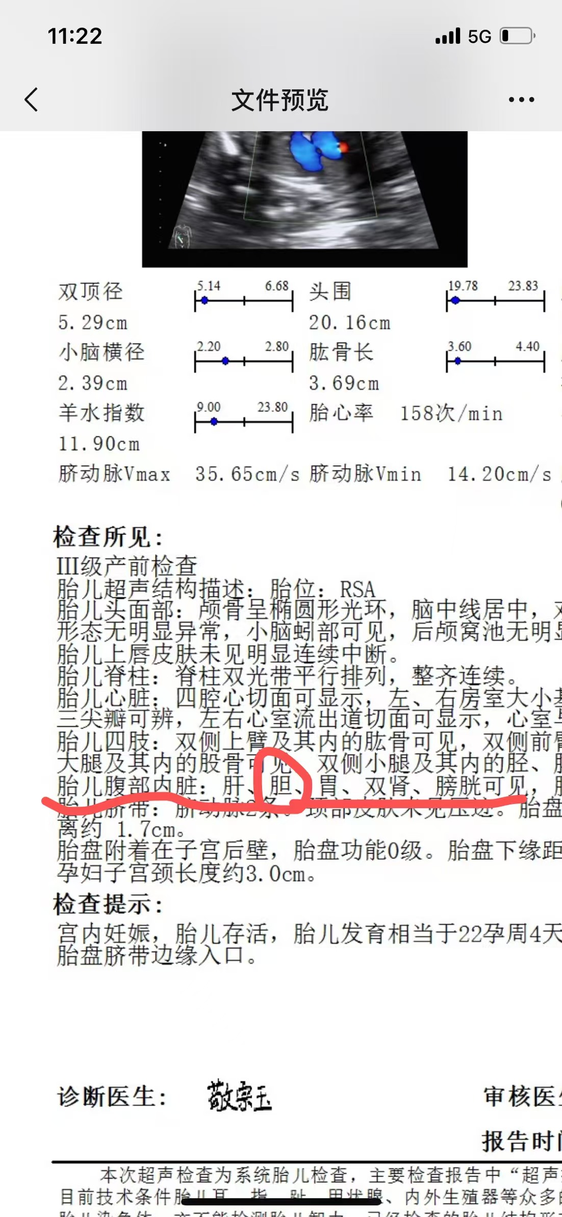 孕期胆囊未显示的焦虑与检查经历