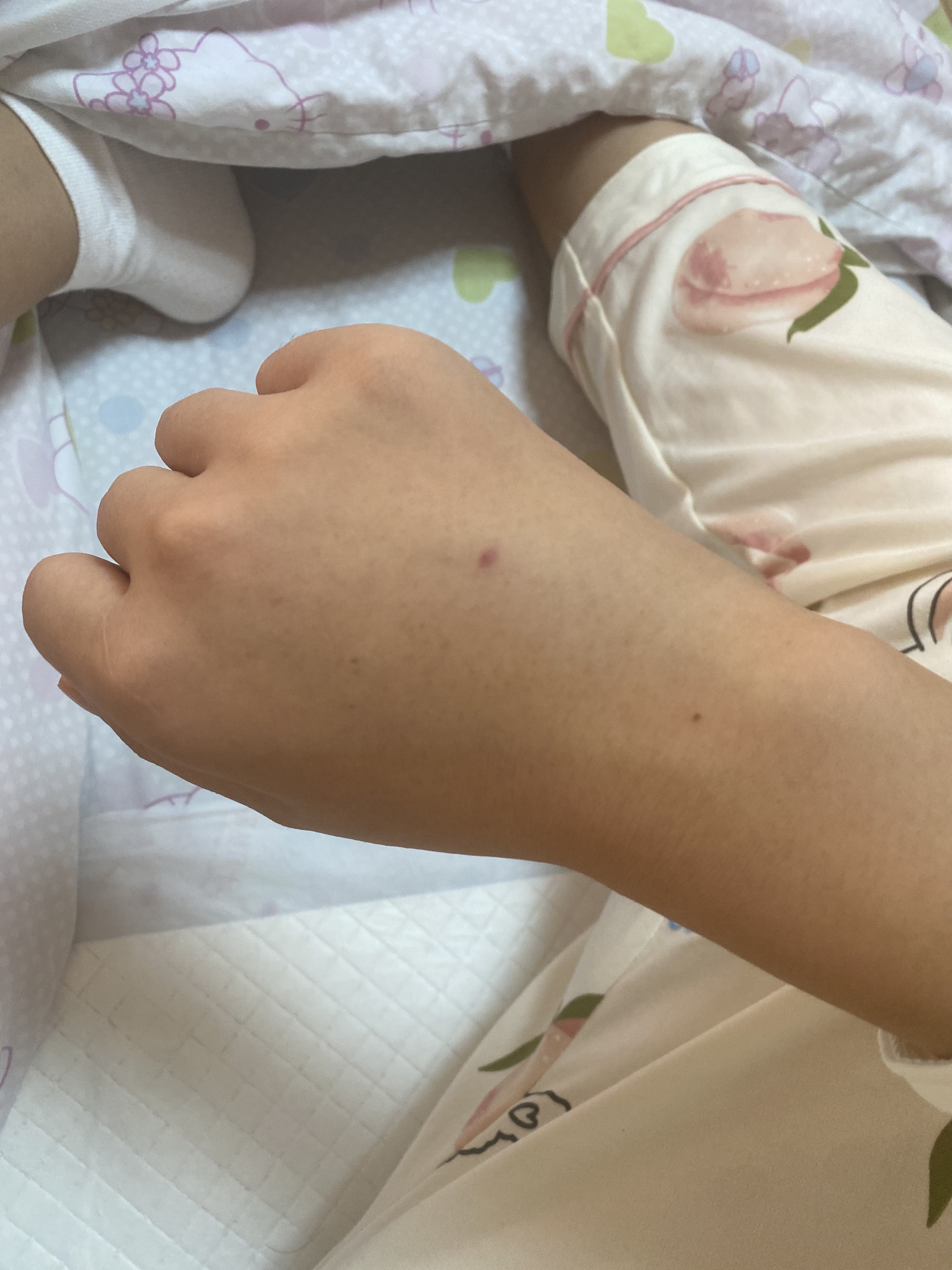 新生儿黄疸问题求助