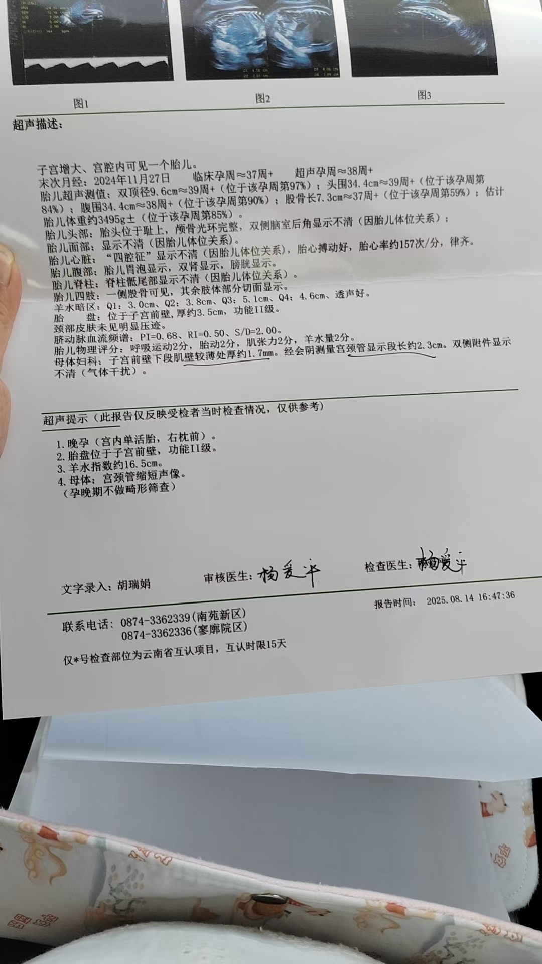 孕期宫颈管短被扣医院，可能要提前剖腹产