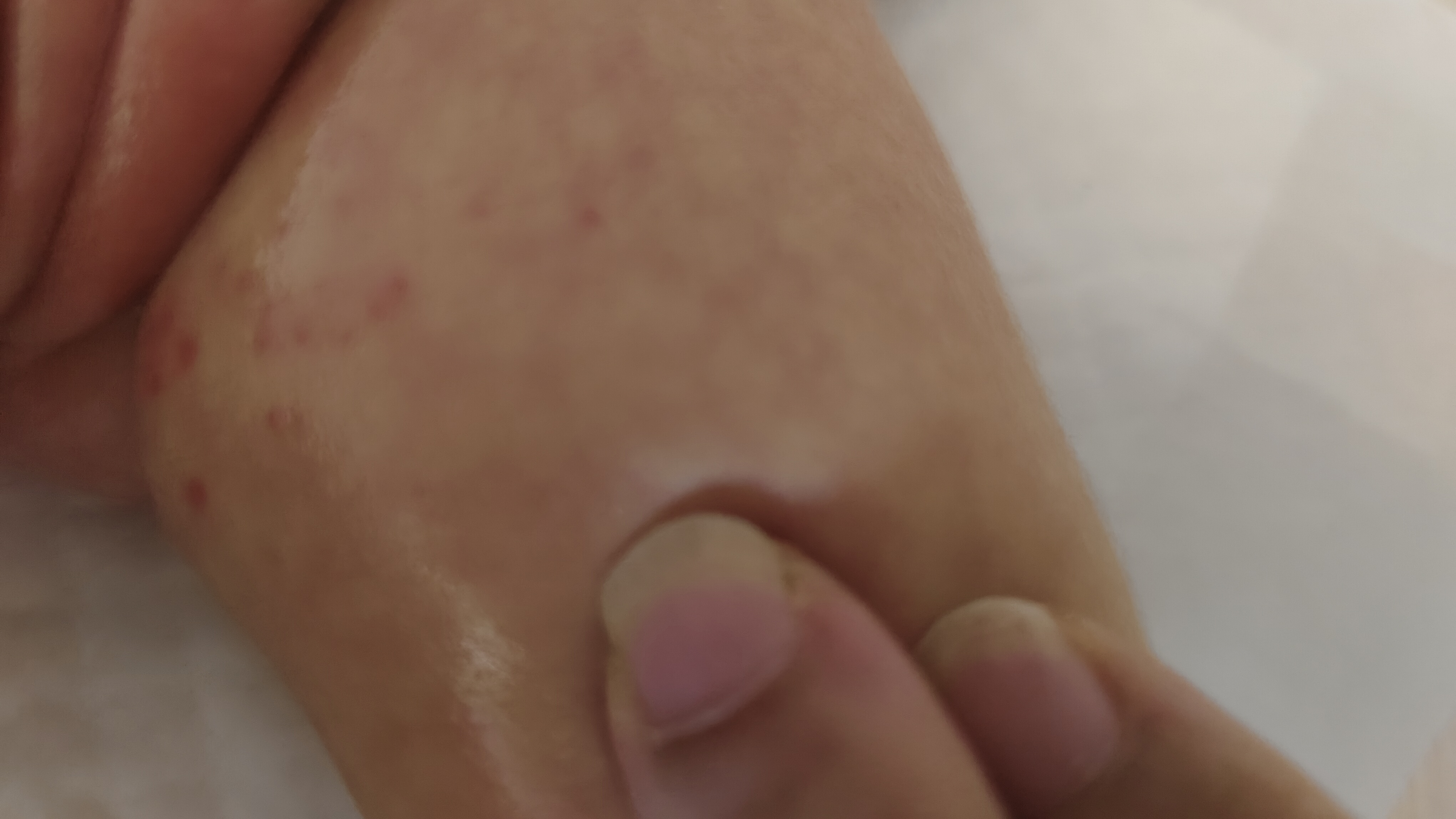 宝宝红屁股怎么办？尿不湿选择经验分享