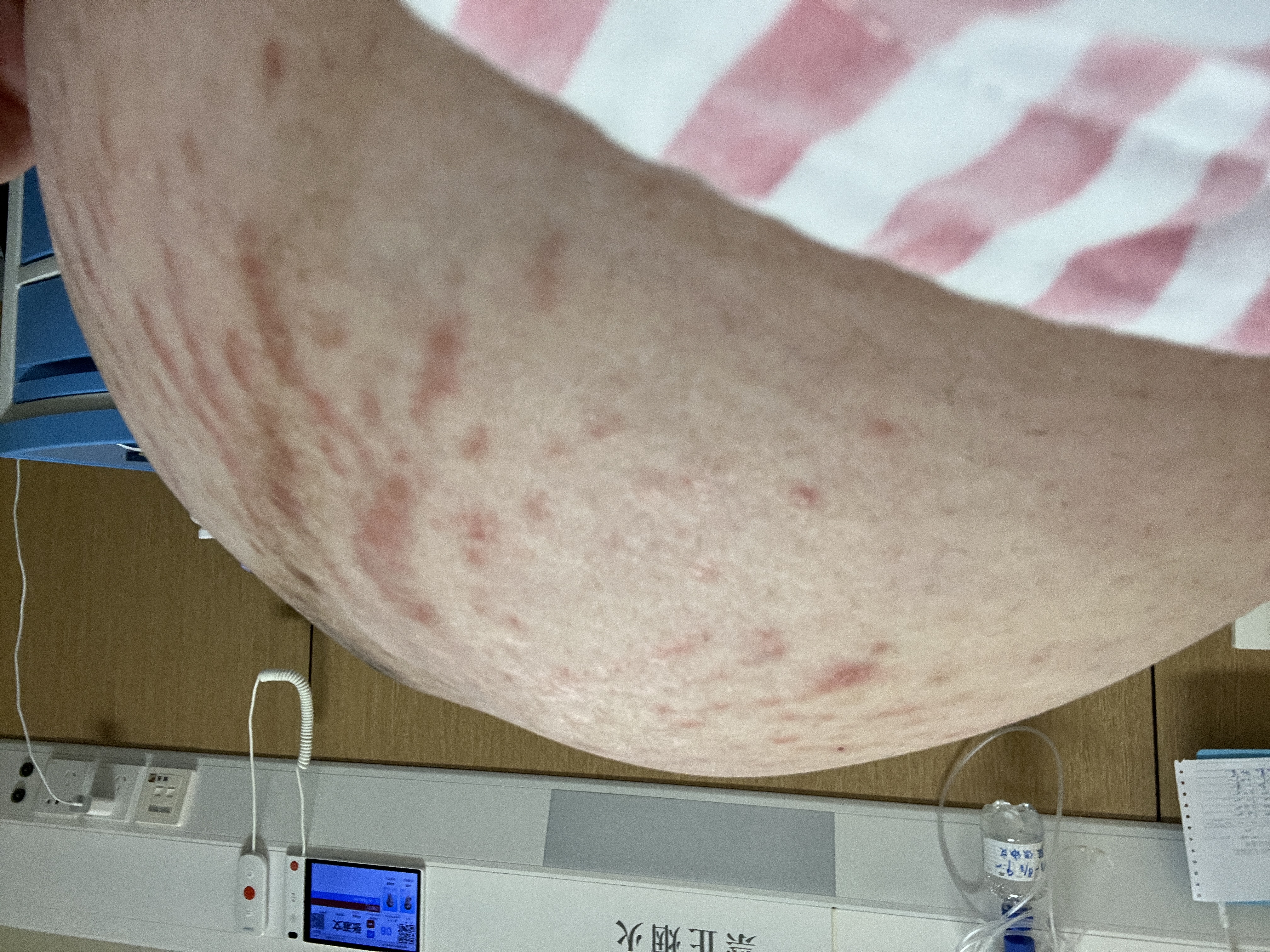 产后湿疹困扰，求推荐安全有效的止痒方法