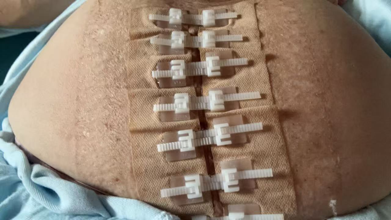 剖腹产伤口护理经验分享