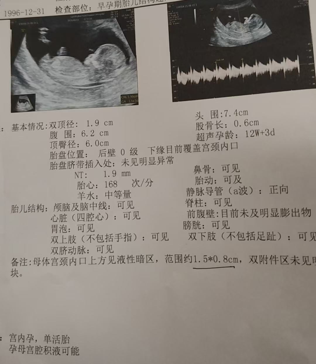 孕期B超检查有必要吗？