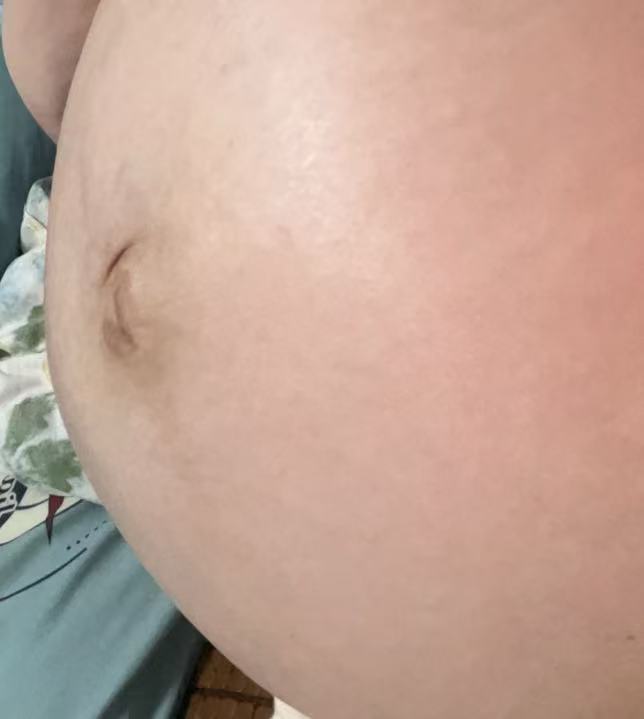 孕晚期假性宫缩的困扰