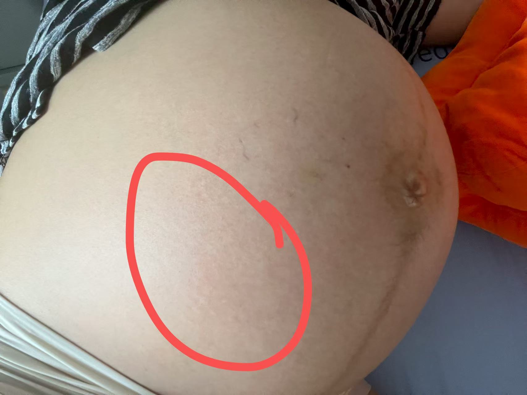 孕晚期便秘困扰