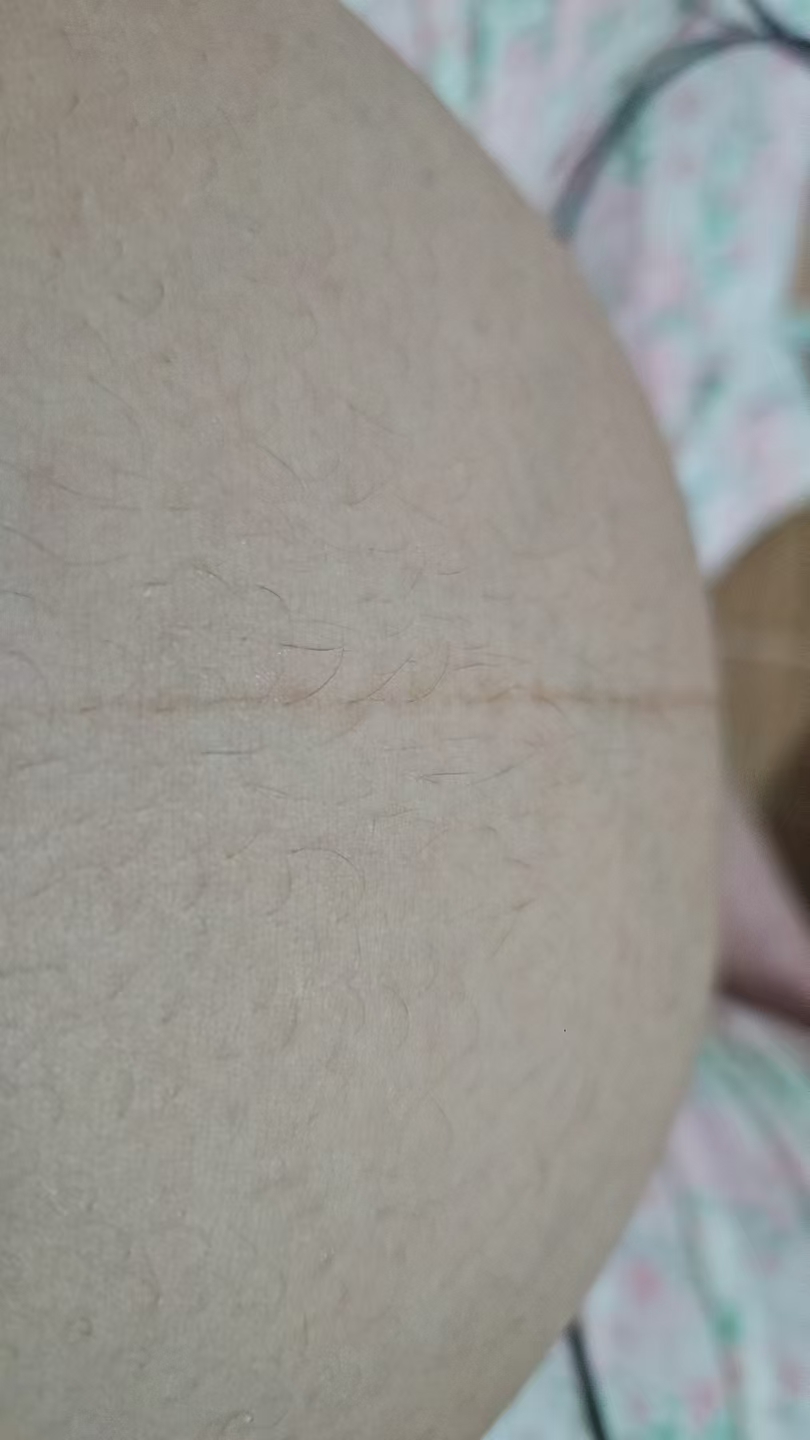 孕晚期肚子长毛和妊娠纹的烦恼