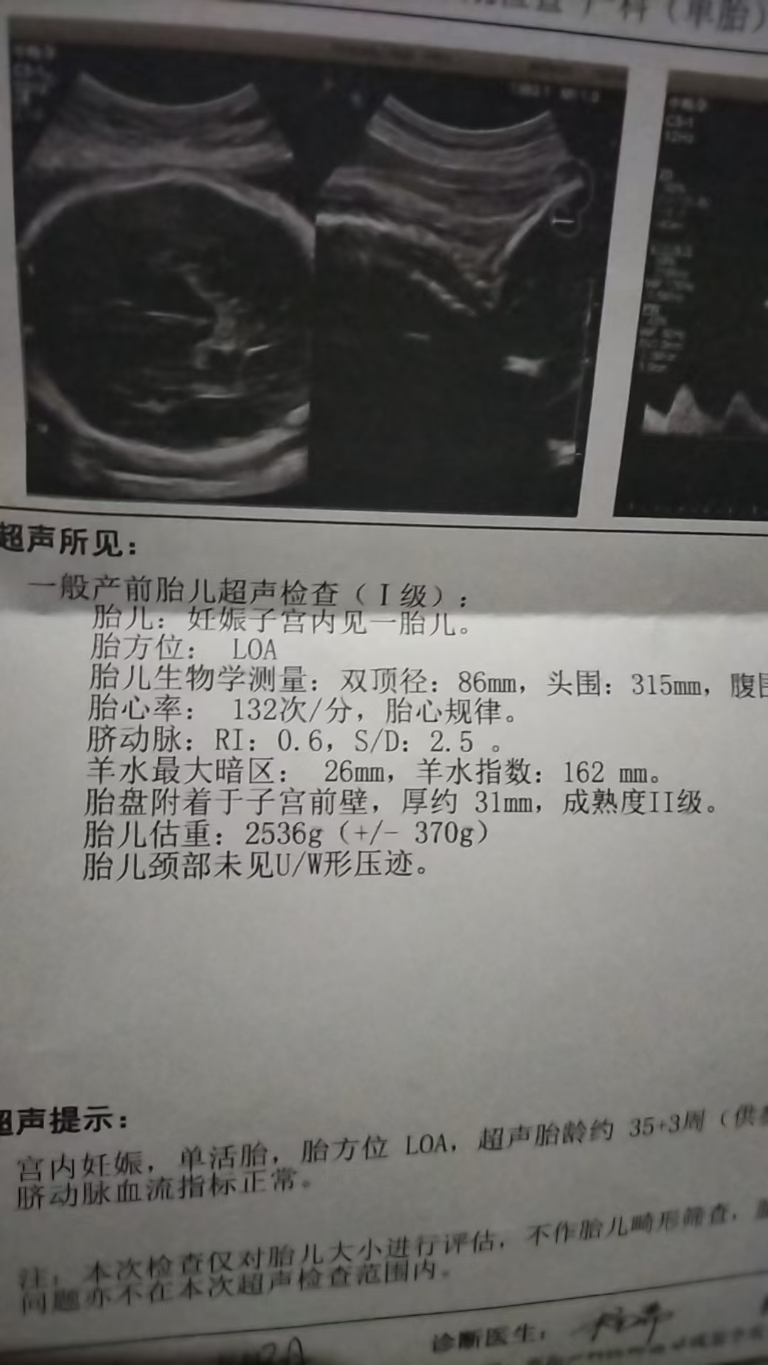 疤痕子宫能否顺产的纠结