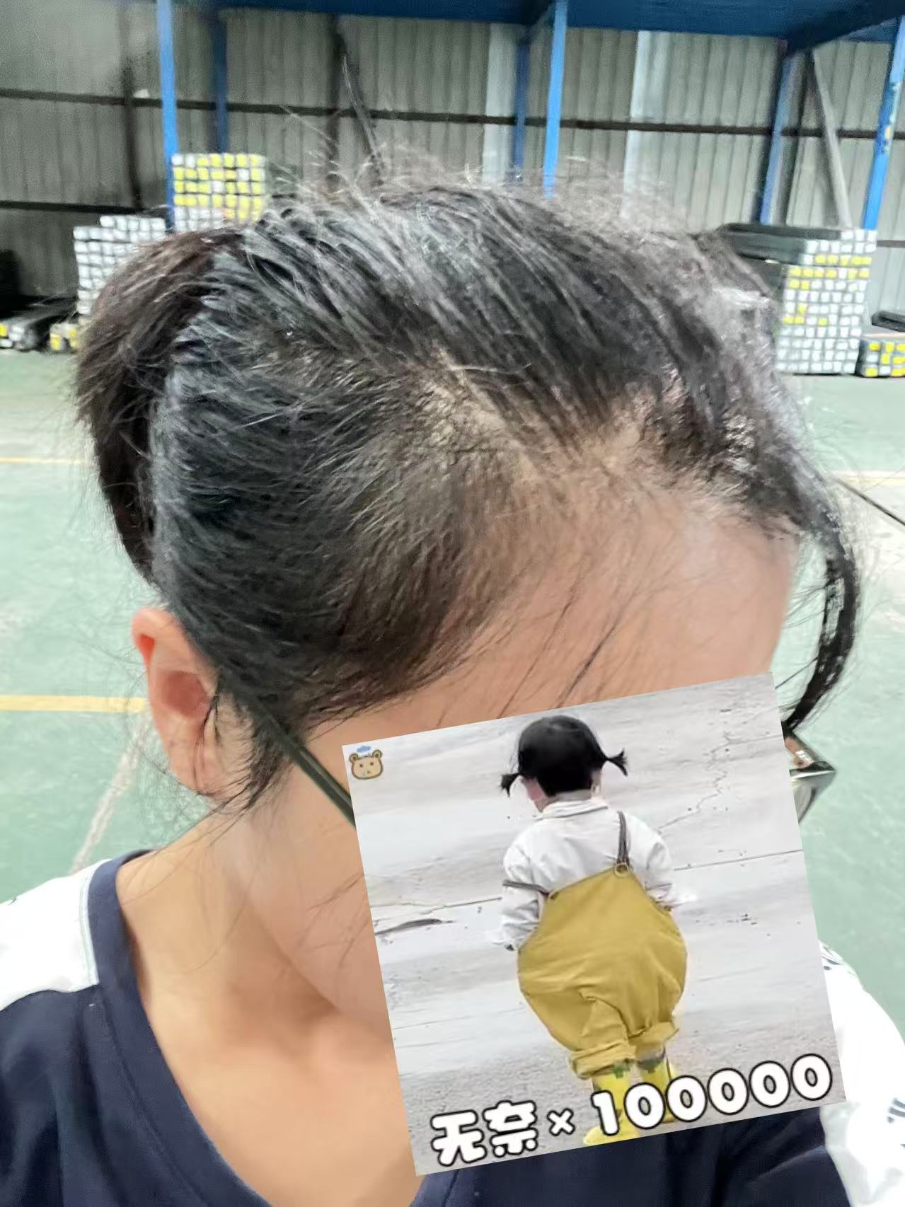 熬夜带娃的脱发困扰