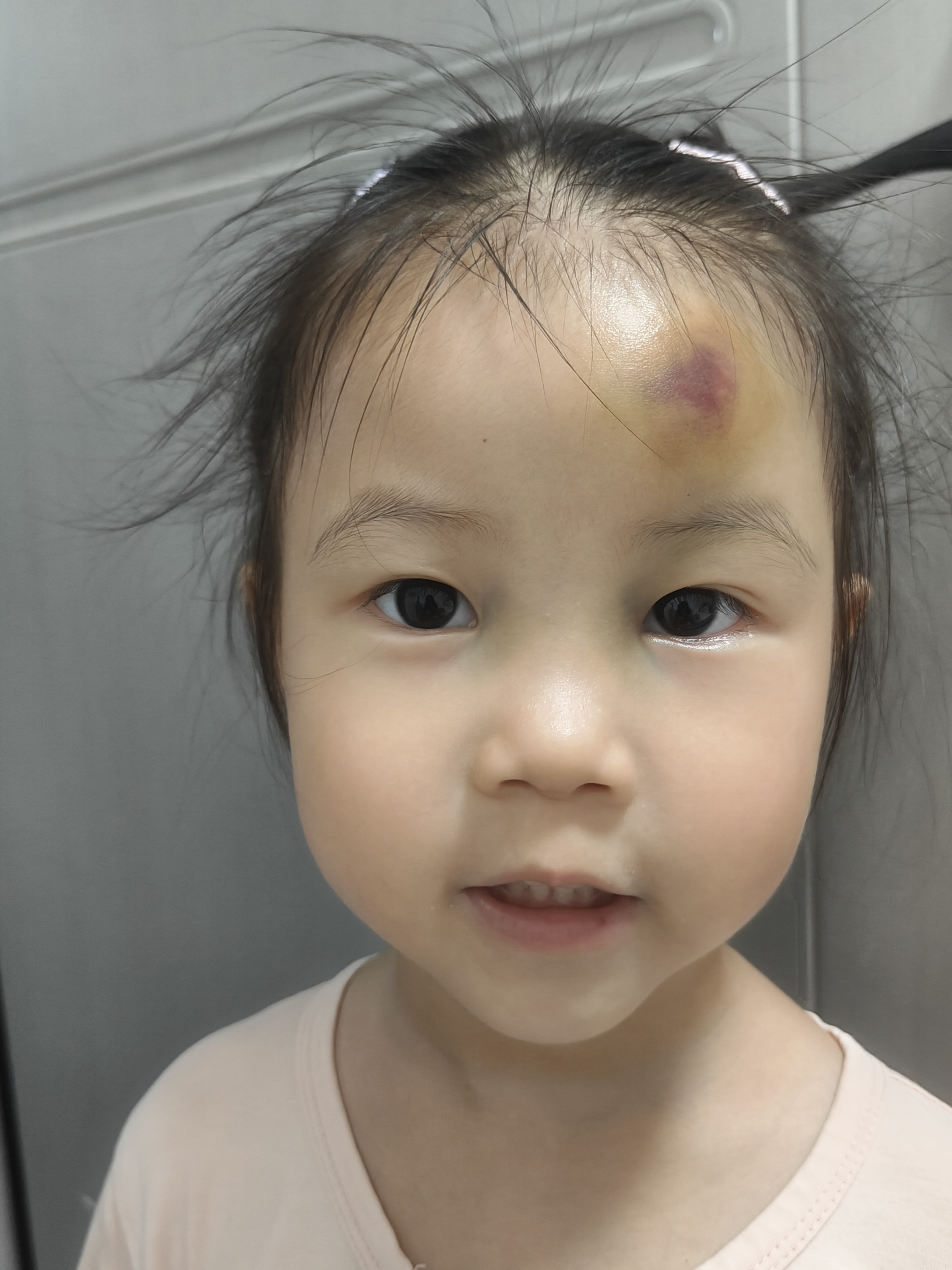 孩子摔倒后眼角发青怎么办？