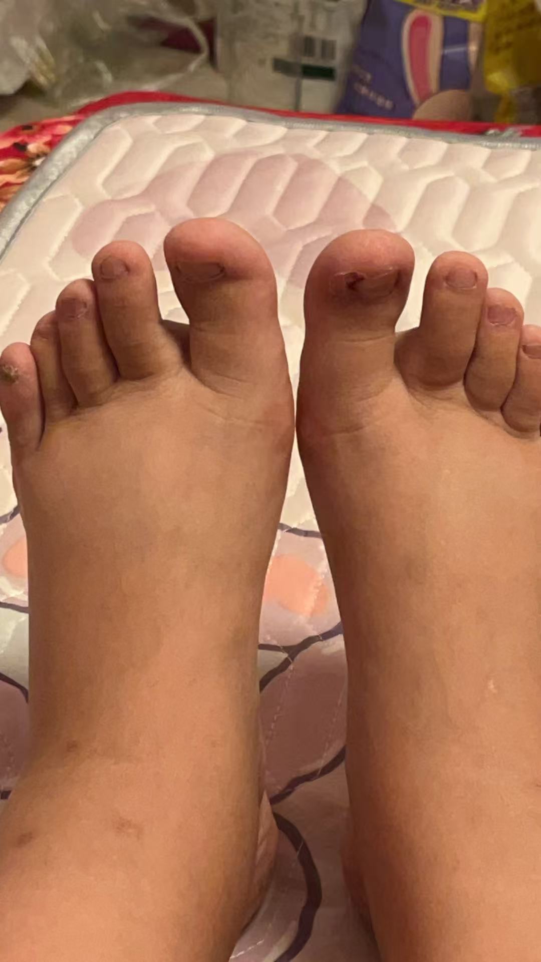 孕期水肿的烦恼