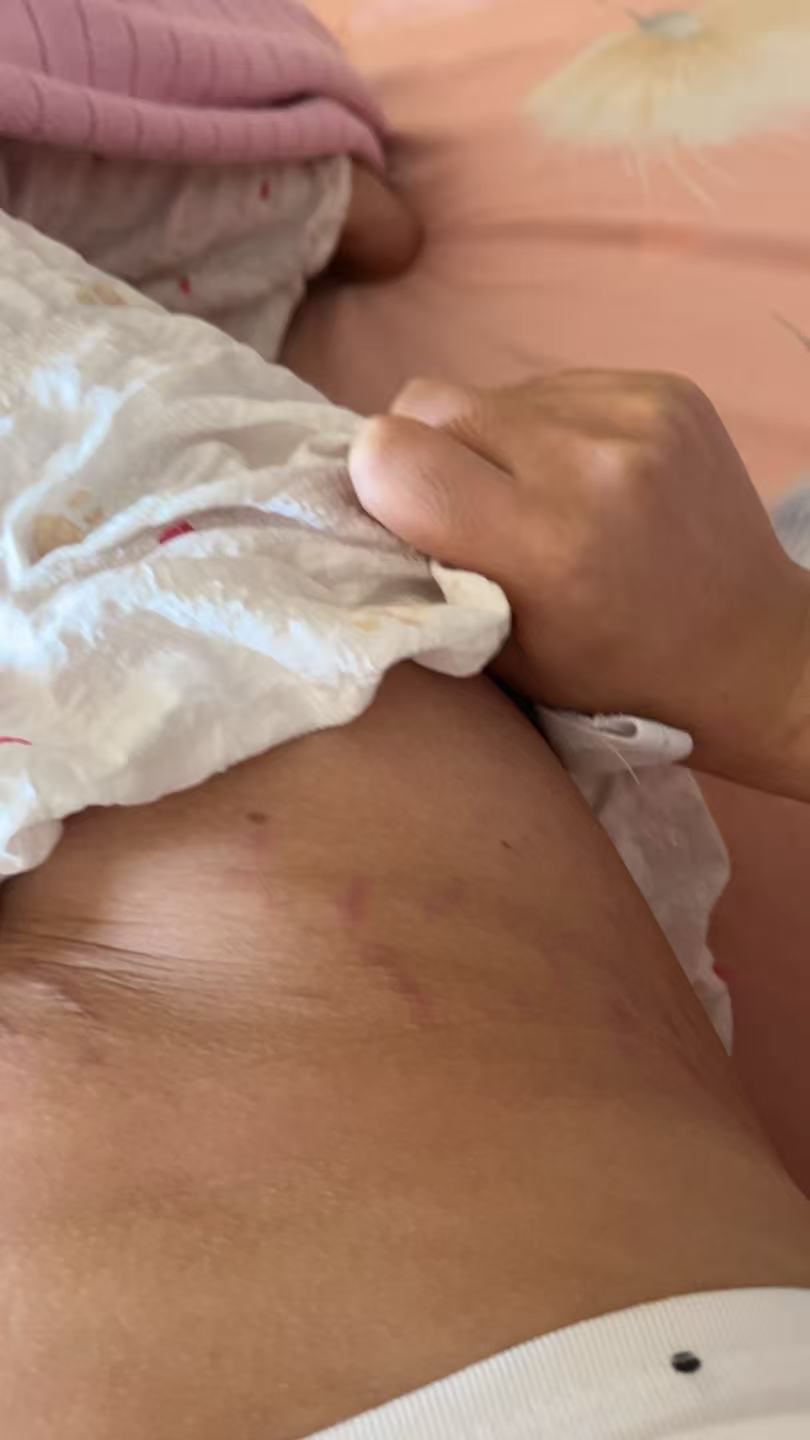 孕晚期肚子纹和剖腹产疤痕的烦恼