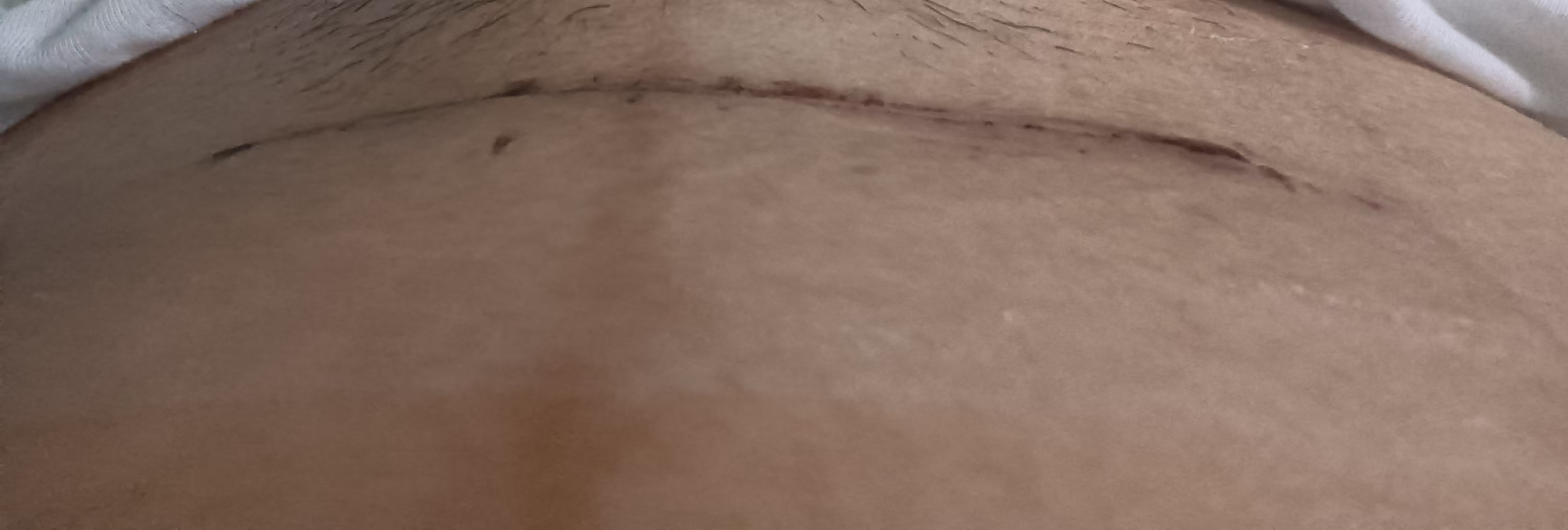 剖腹产伤口护理经验分享