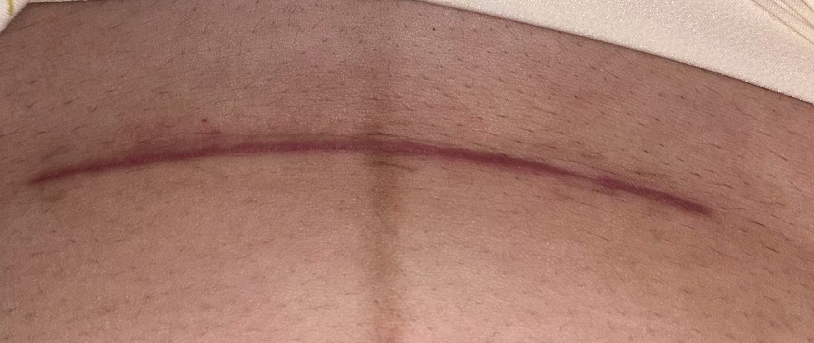 剖腹产伤口护理经验分享