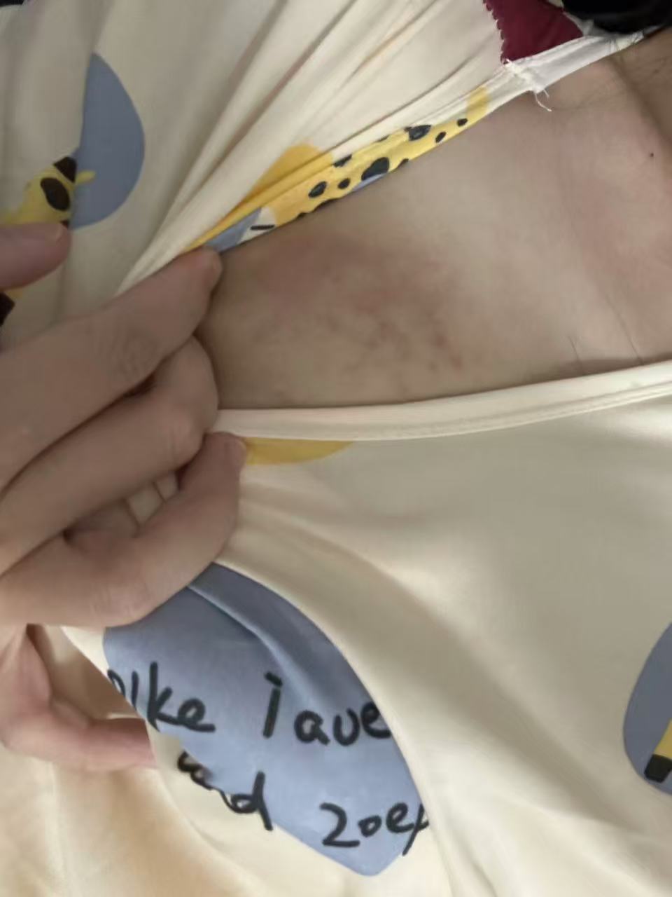 孕期皮肤瘙痒怎么办？