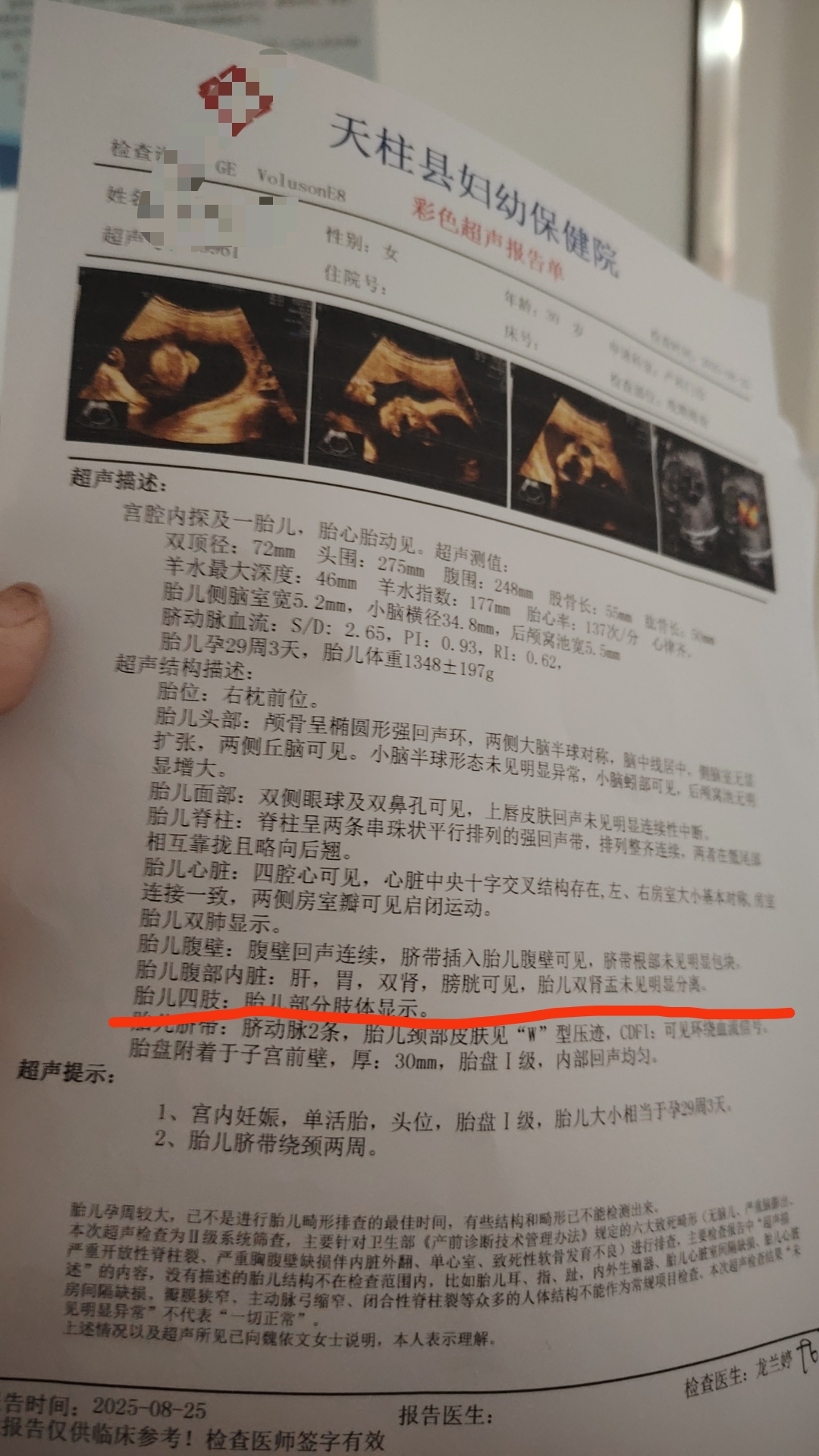 孕期耻骨痛的困扰