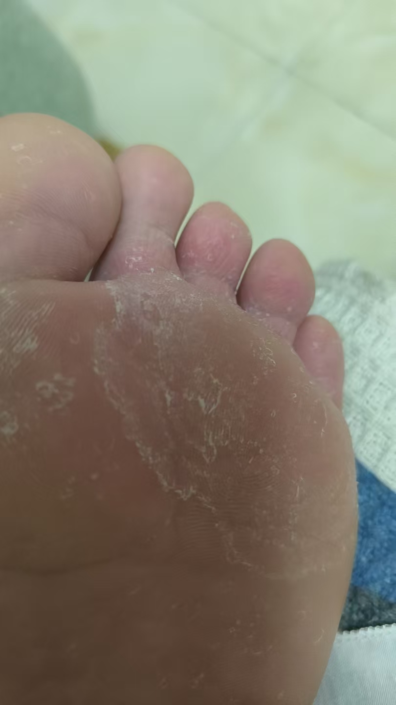 孕期脚部瘙痒难忍，如何缓解？