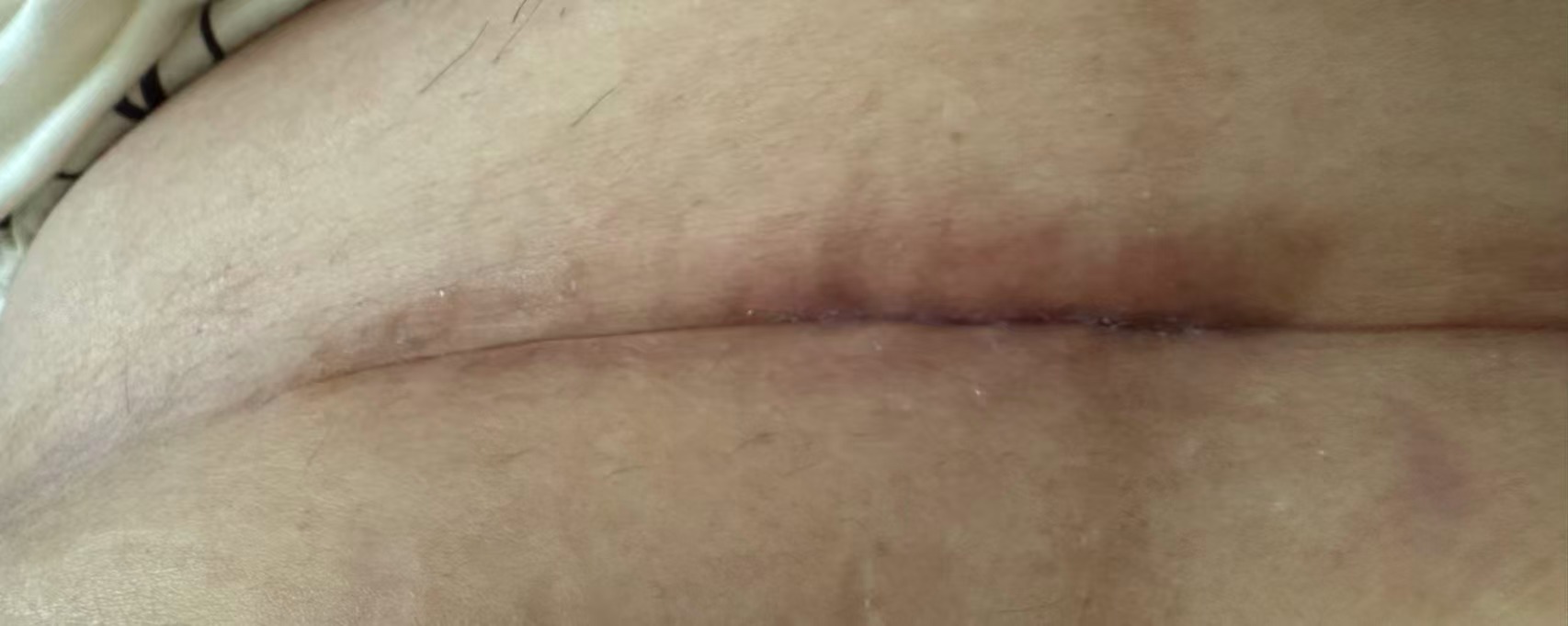剖腹产伤口不溶线二次处理的痛苦经历