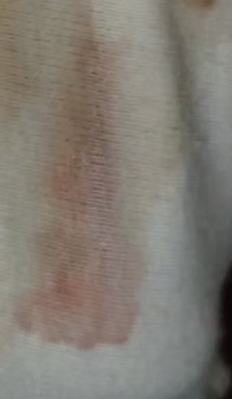 剖腹产前的焦虑与准备