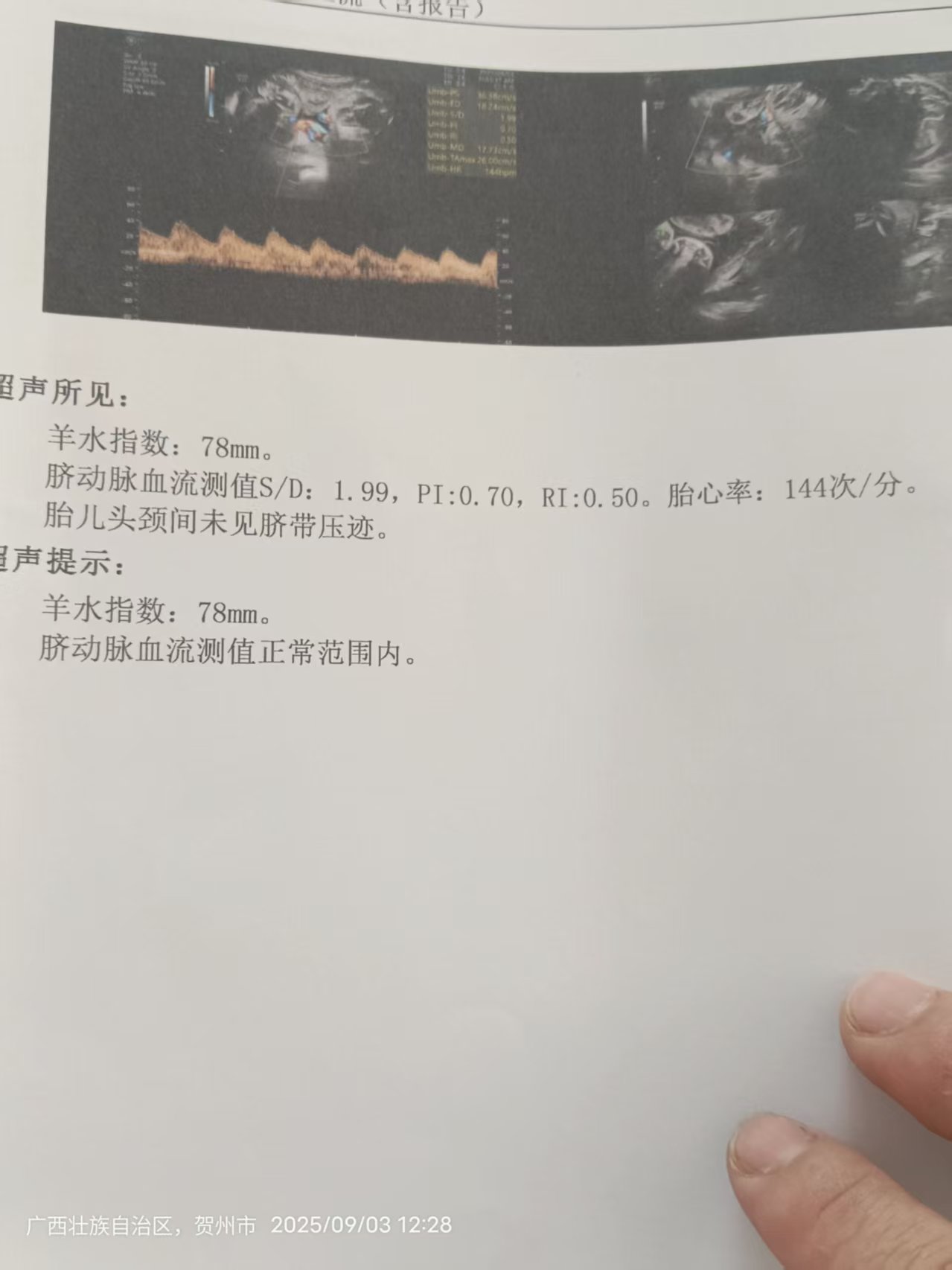 孕期体重增长和血糖控制