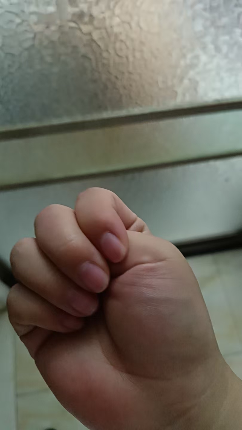 宝宝拇指内扣怎么办？