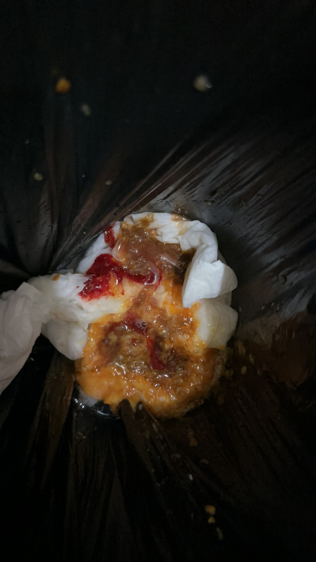 孕早期胃出血住院经历分享