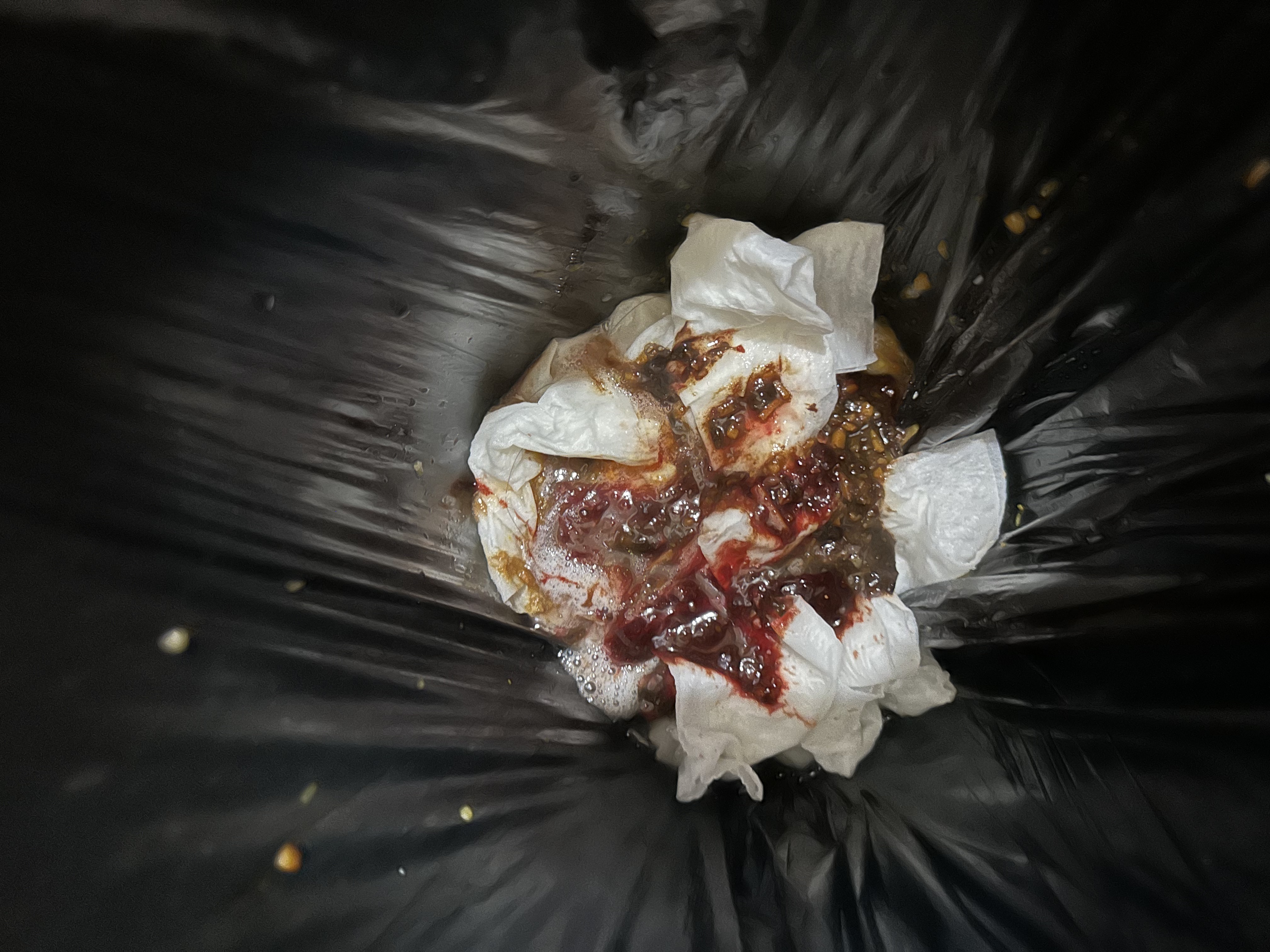 孕吐到胃出血住院，孕早期真的太煎熬了