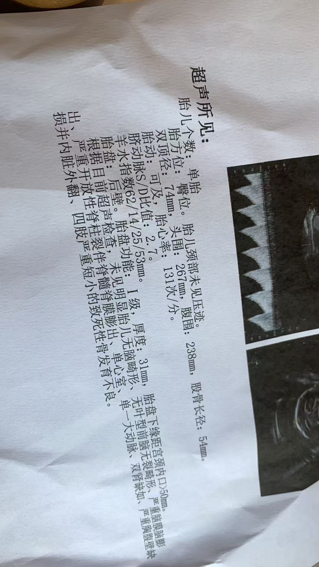 孕期失眠困扰