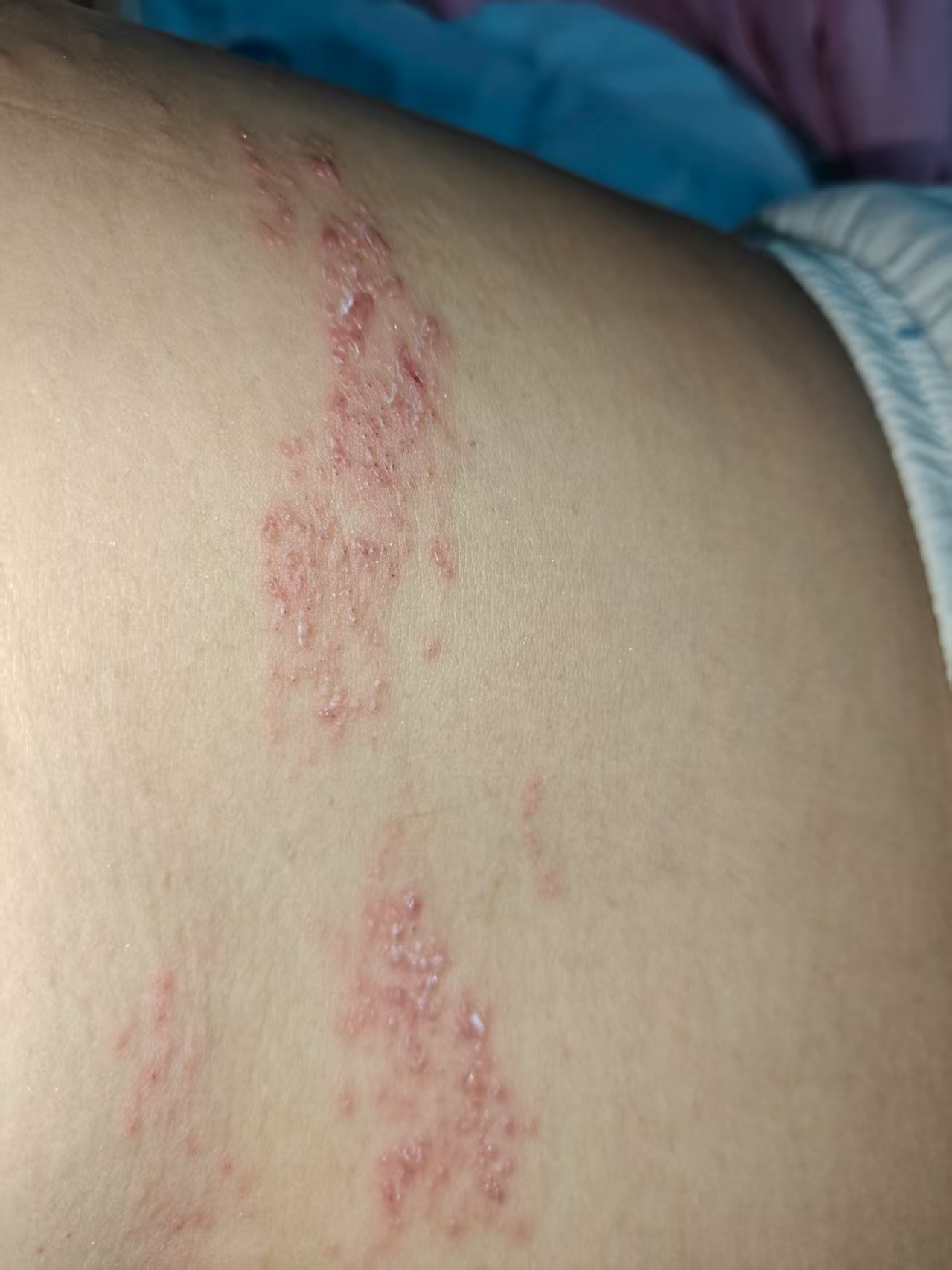 孕晚期遭遇带状疱疹的煎熬