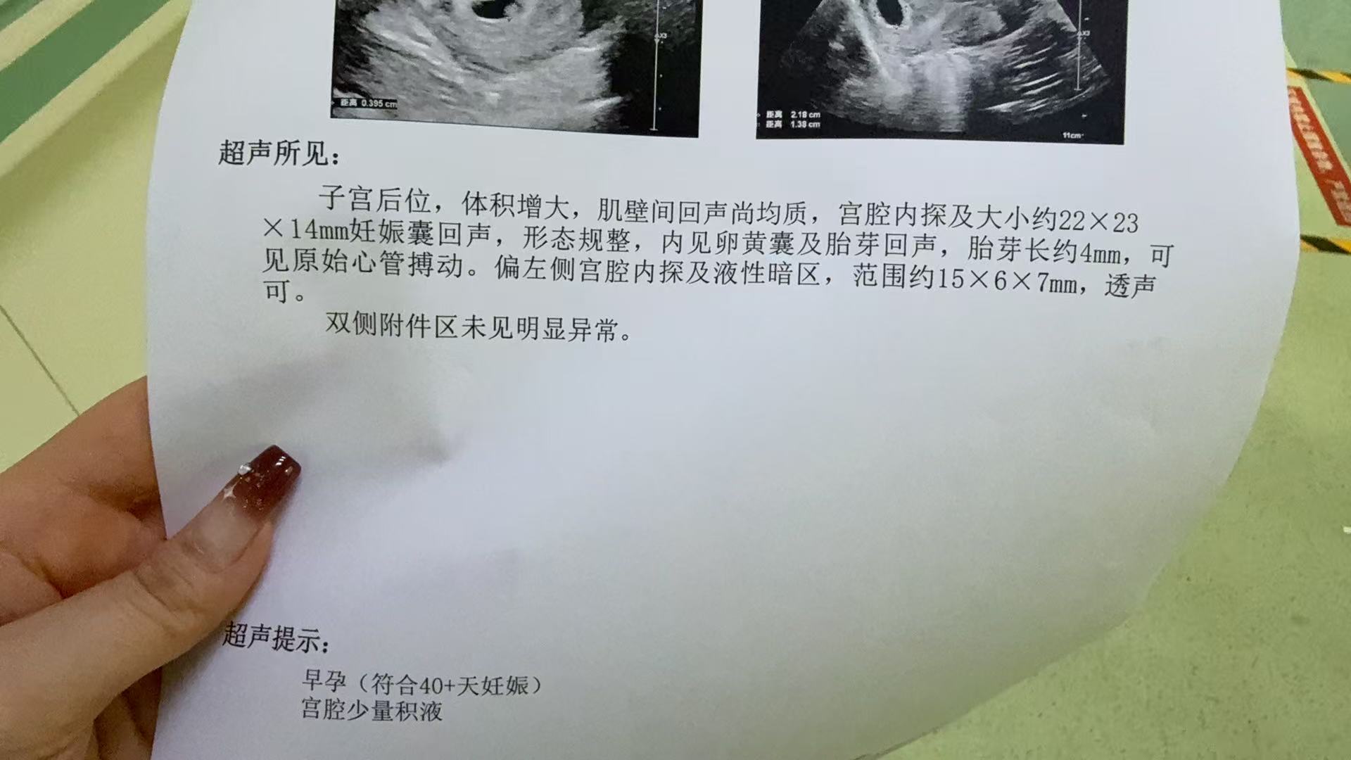 孕早期孕吐与体重变化的困扰