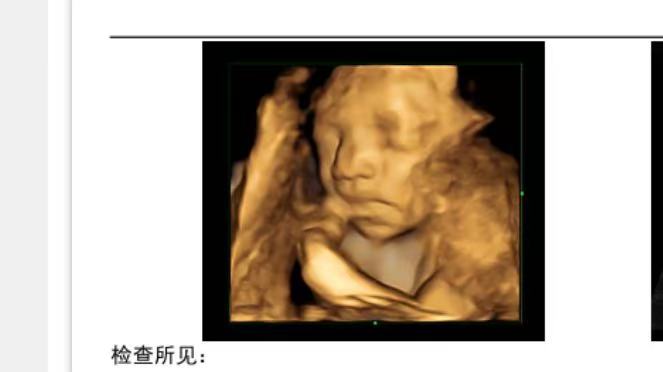 孕期控糖的烦恼与美食诱惑