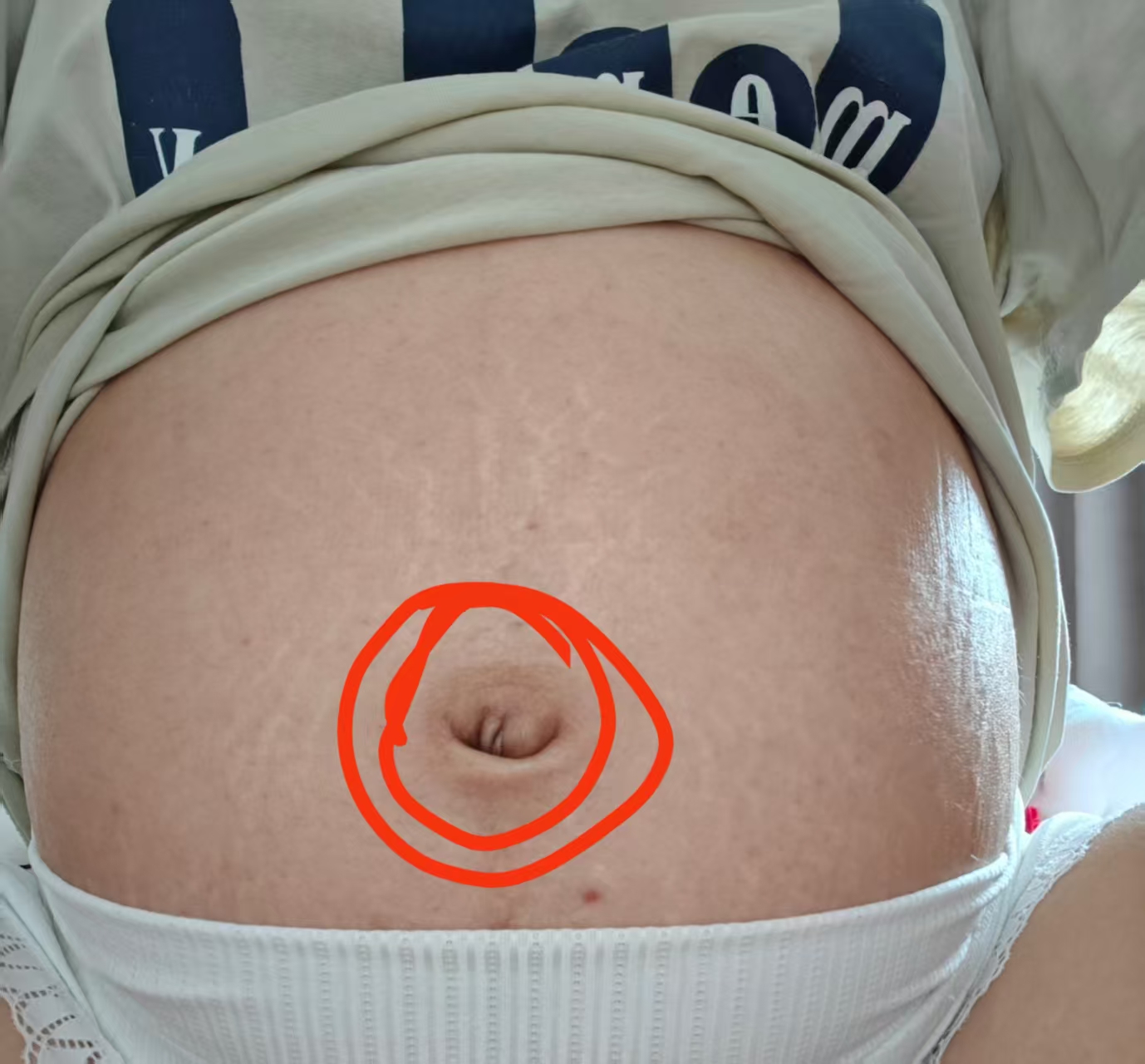 孕期肚脐眼疼痛求助