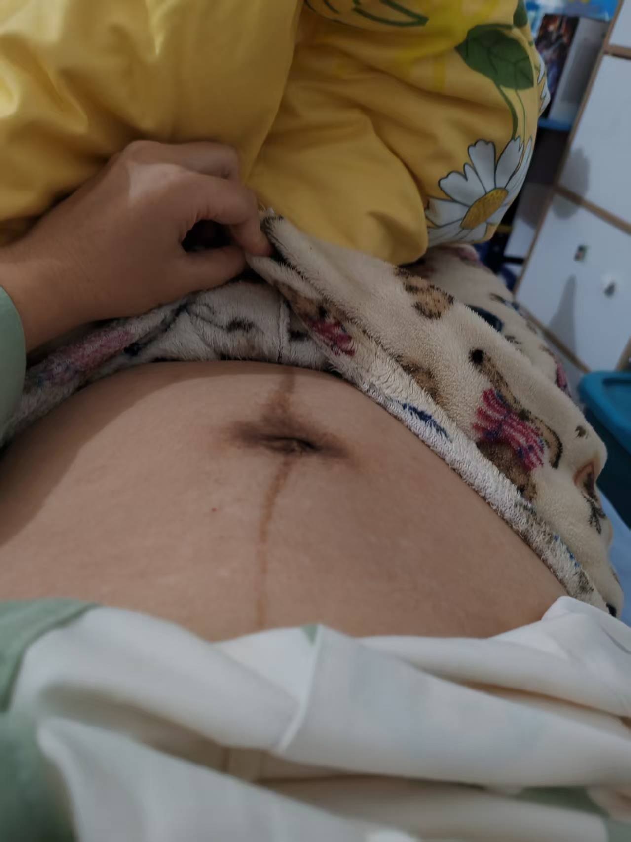 产后肚皮恢复的烦恼