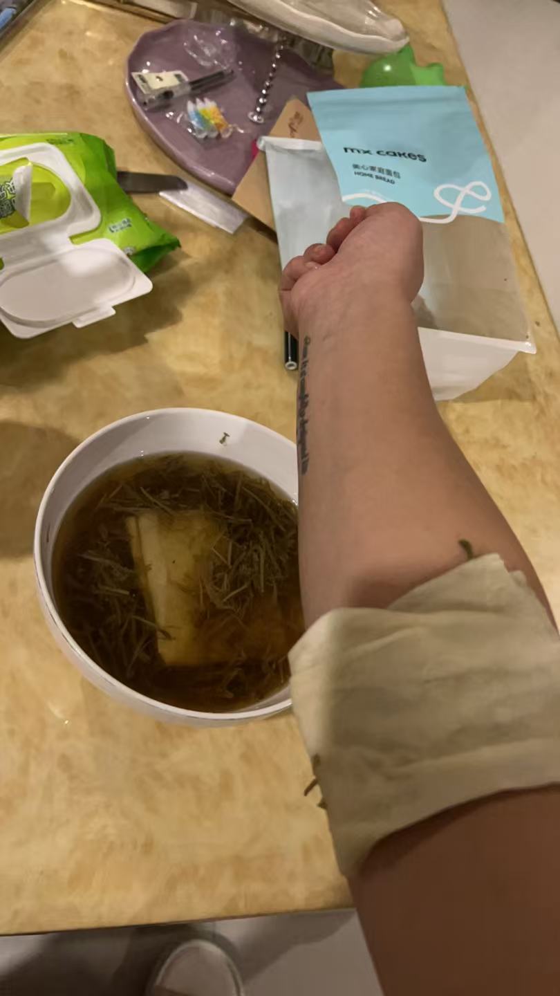 孕期湿疹困扰