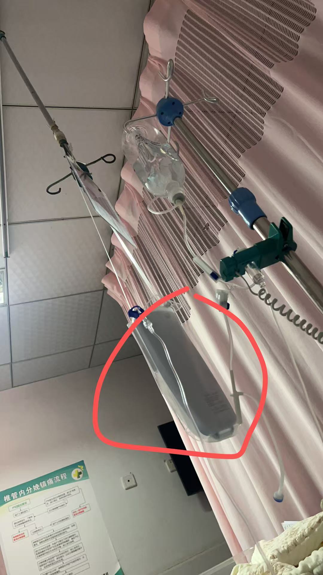 剖腹产后的疼痛与恢复