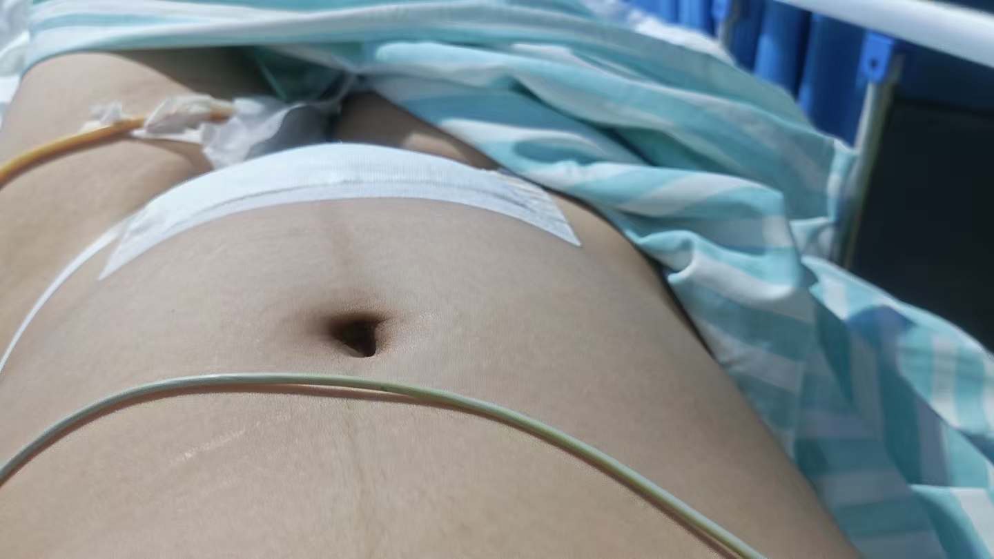 剖腹产后的疼痛与恢复
