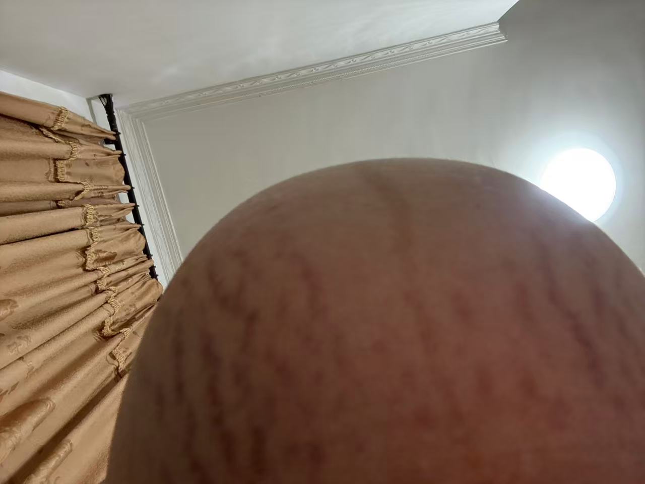 孕期妊娠纹的烦恼