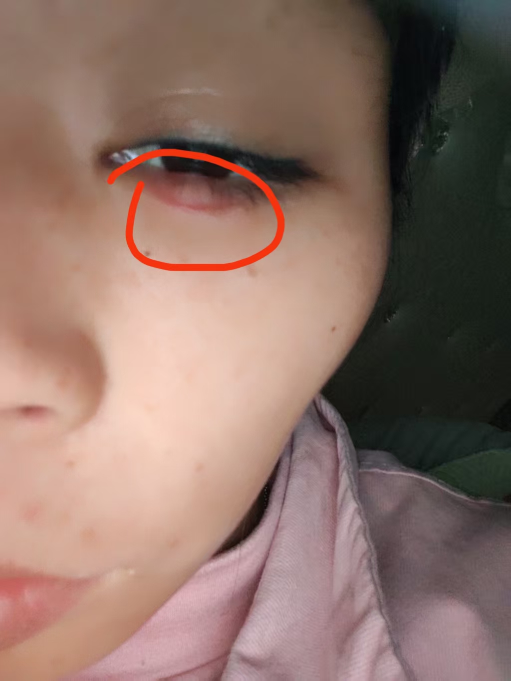 孕期水肿困扰