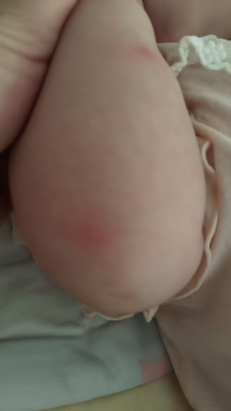 宝宝疹子护理心得