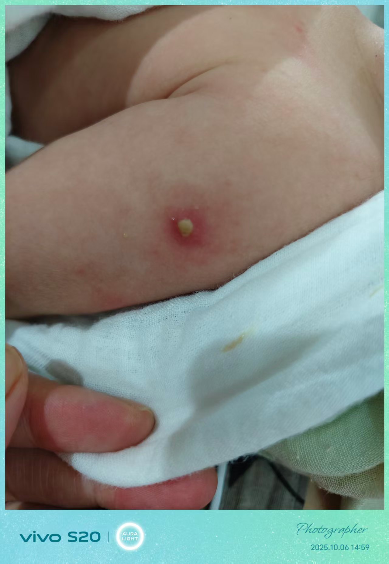 宝宝卡介苗接种后出现脓包怎么办
