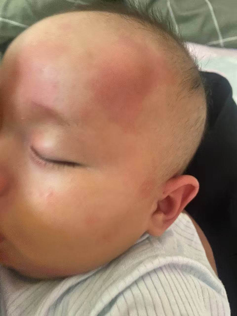 宝宝被蚊子叮咬怎么办？