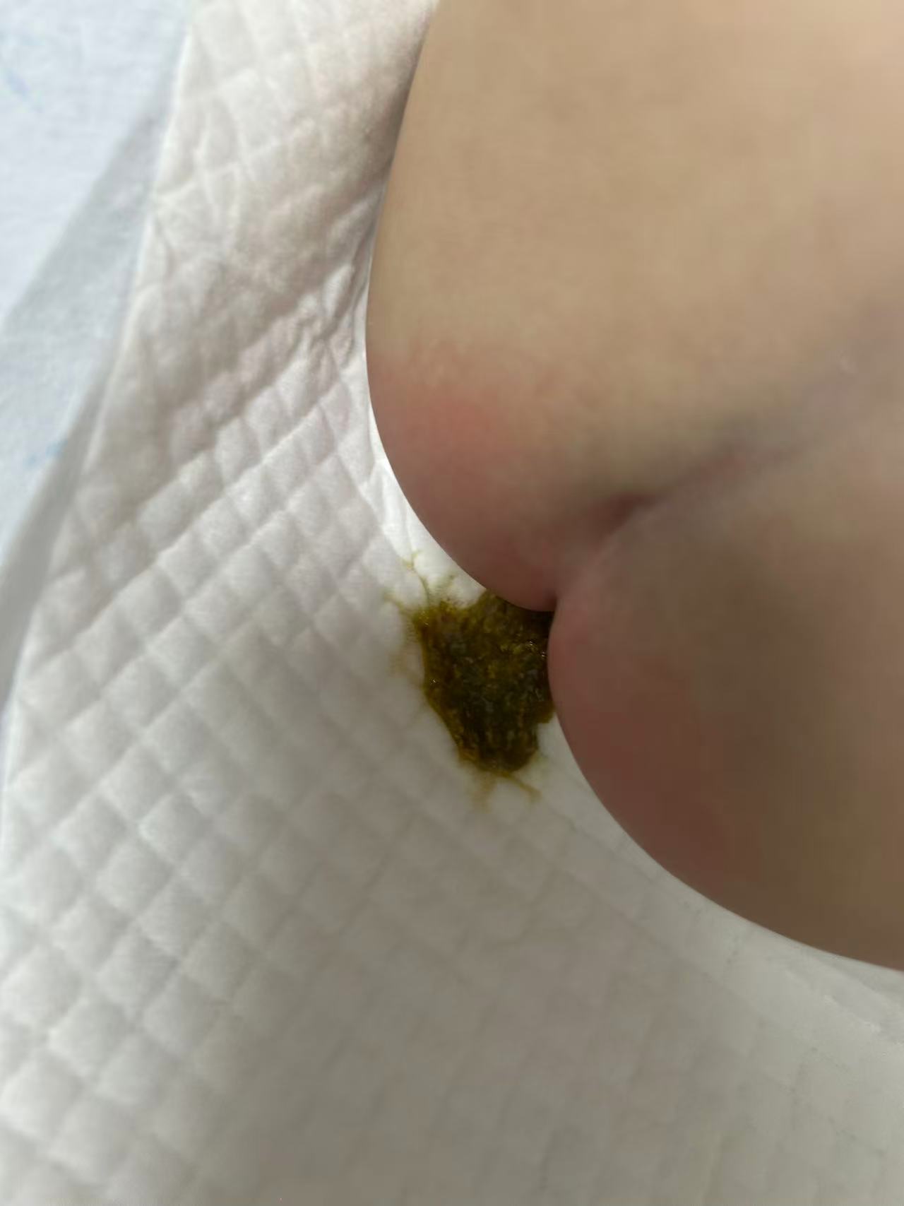 轮状病毒感染经历分享