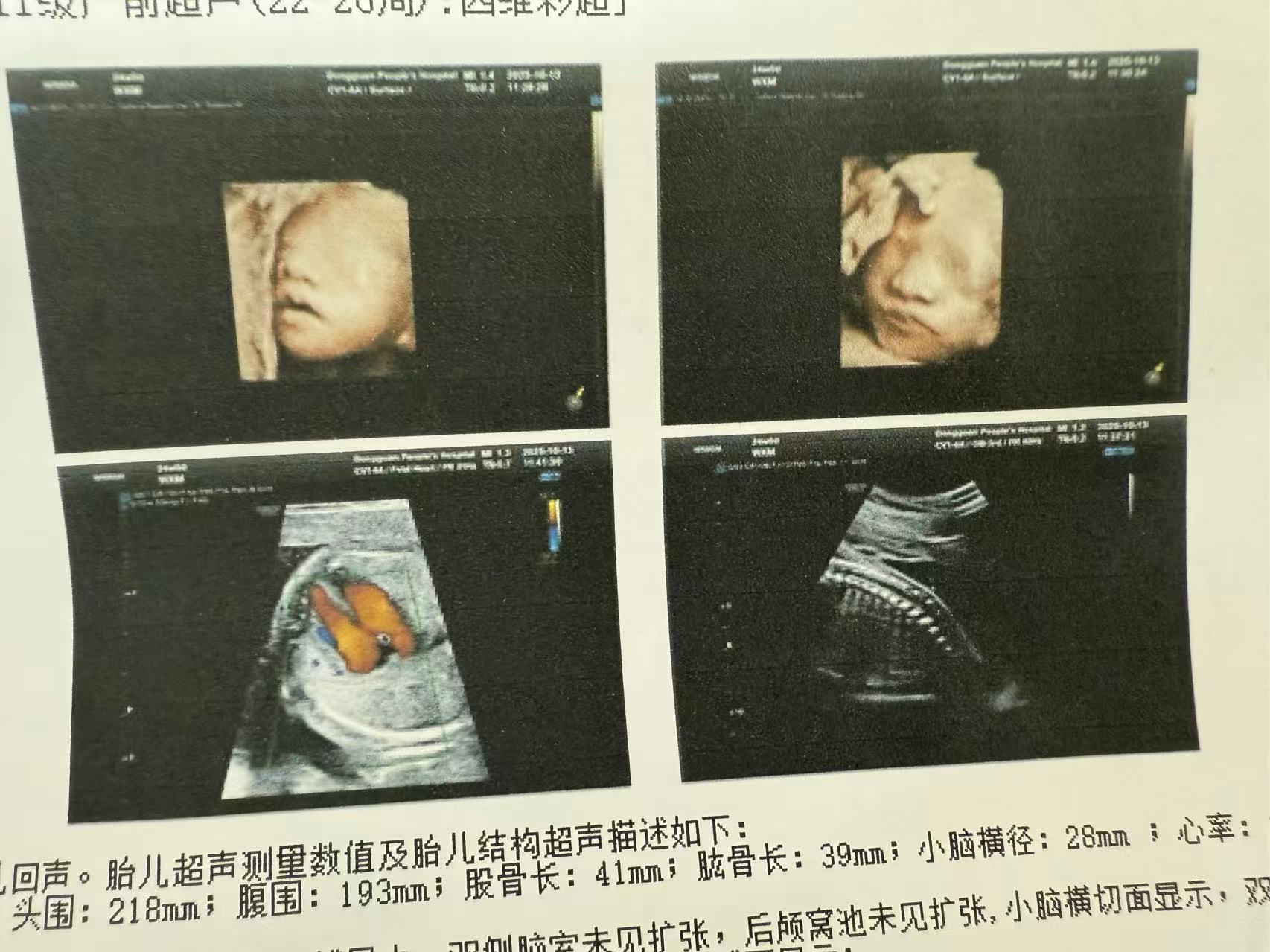 孕期体重控制与营养均衡的烦恼