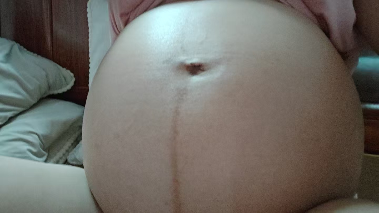 孕晚期羊水过多的困扰