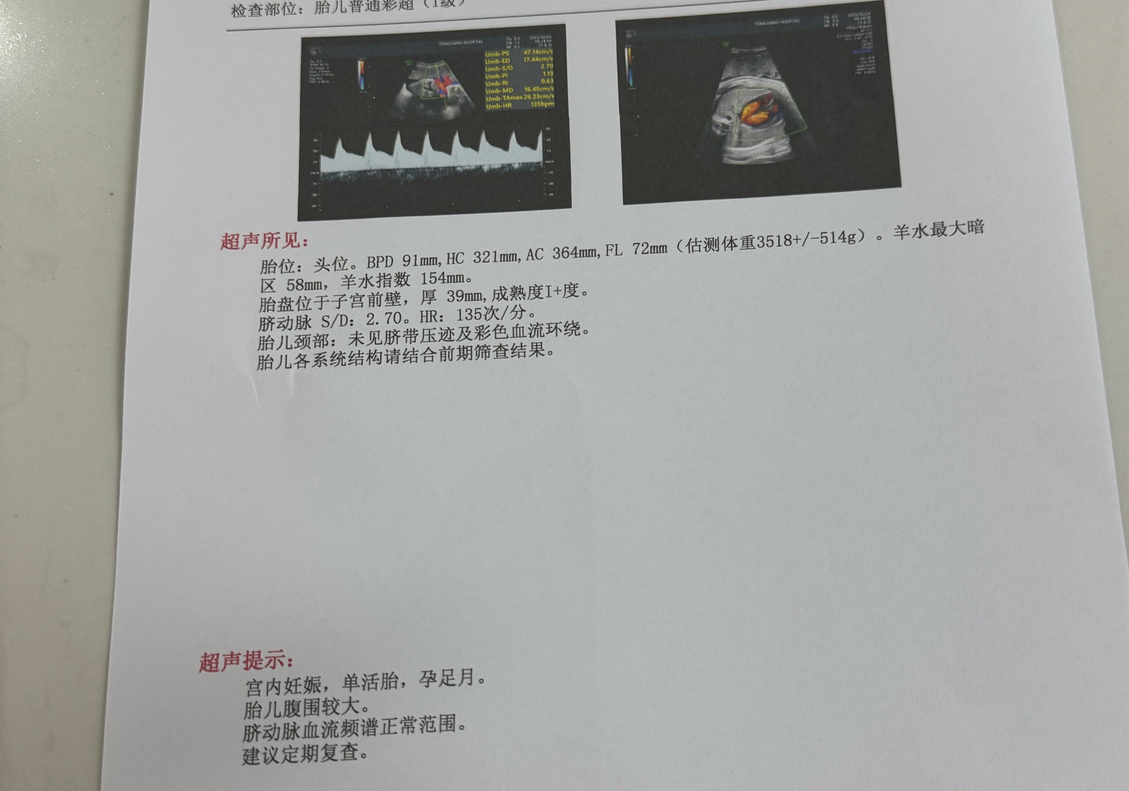 孕晚期B超估重与实际体重差异大