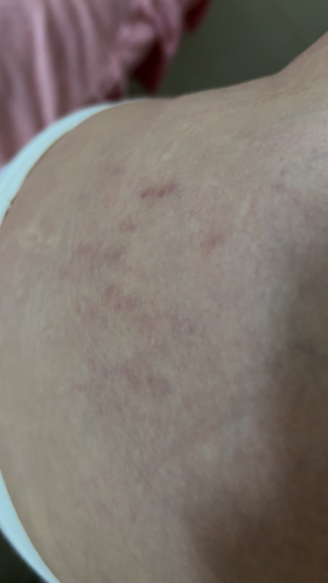 孕期体重增长与妊娠纹的烦恼