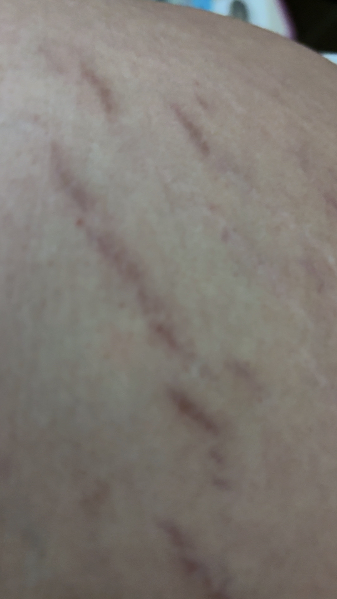 孕期体重增长与妊娠纹的烦恼