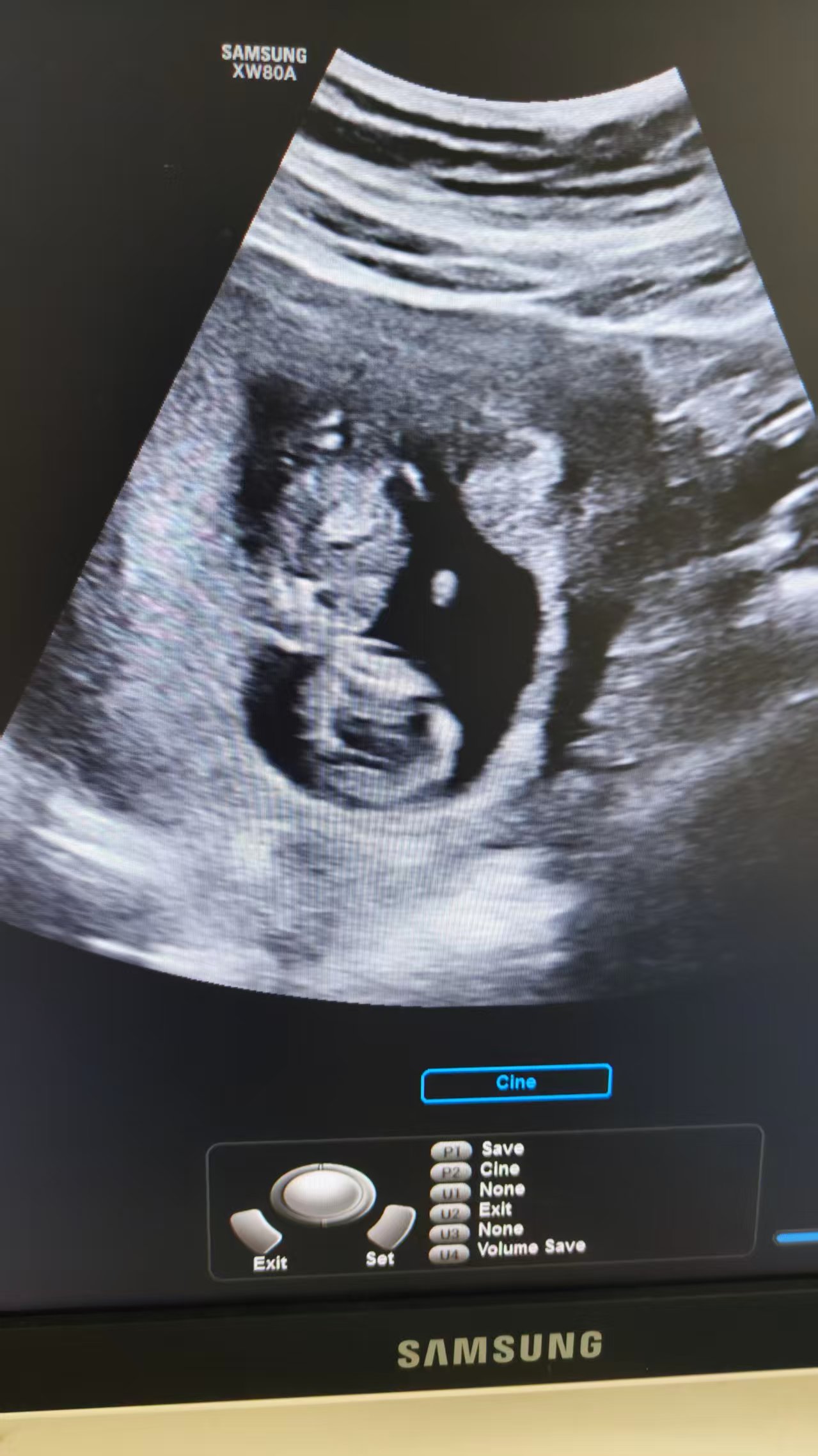 NT检查的曲折经历